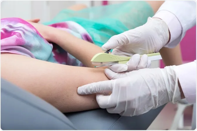 Na rede privada, Implanon custa até R$ 4 mil.